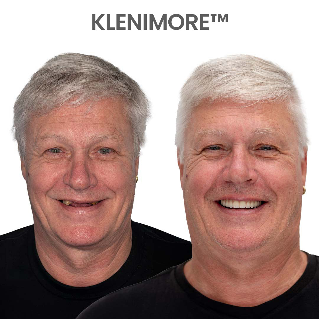⏰ Custom-Fit Dentures ENDS TODAY 50% OFF | Smile with Confidence|Buy 2, Get 1 Free